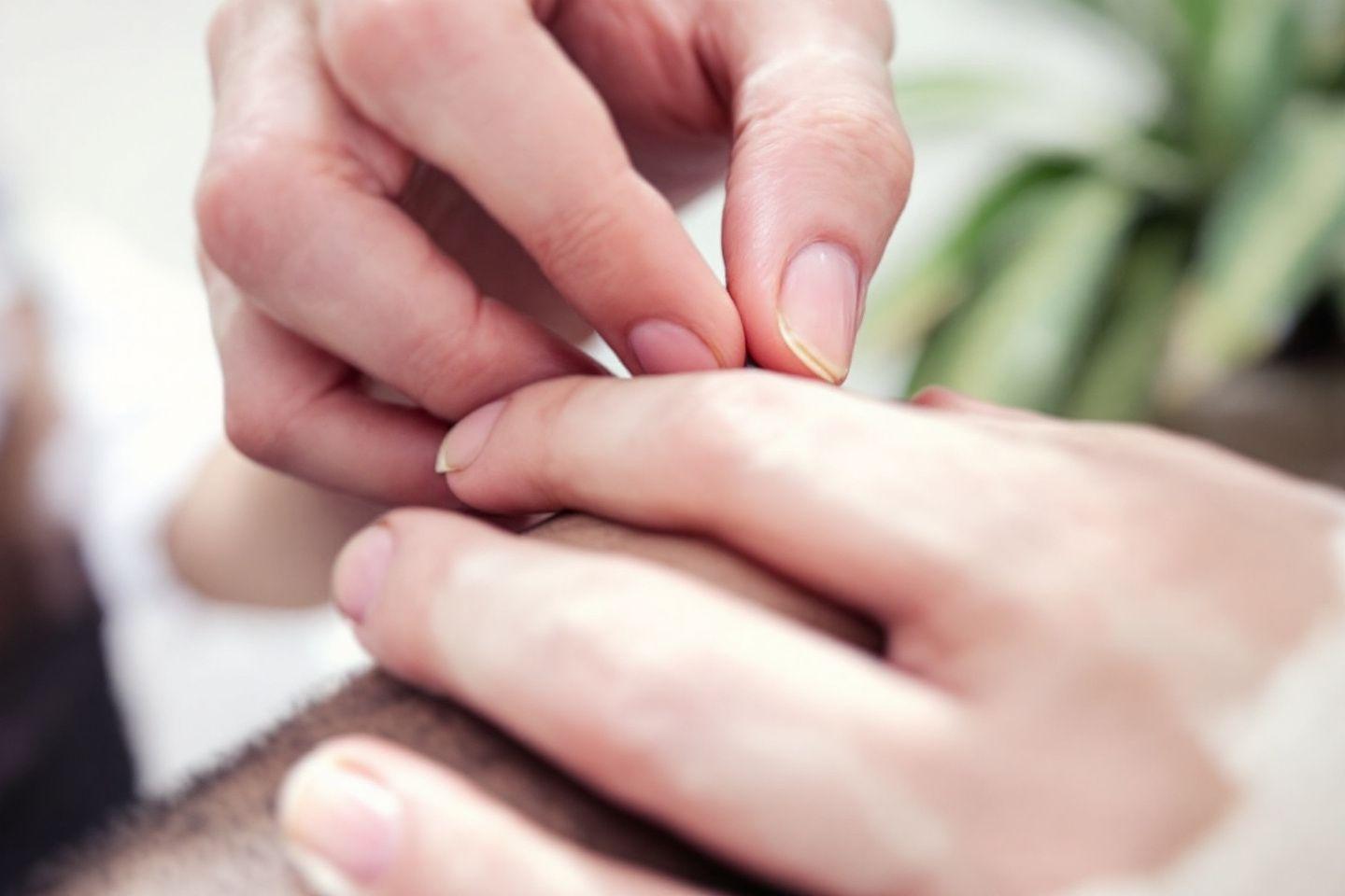 Acupuncture : effet au bout de combien de temps ?