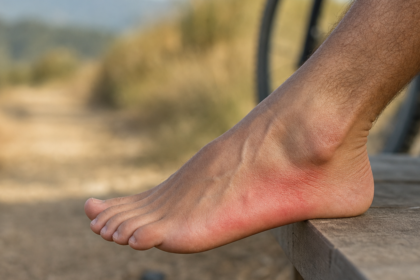 Inflammation et douleur sur le côté extérieur du pied : causes et solutions